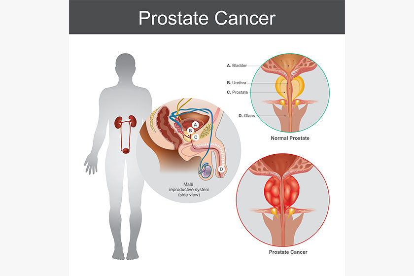 Healthy Lifestyle Changes To Make To Prevent Prostate Cancer In Your ...